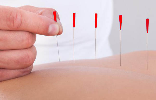 Dry Needling in NH